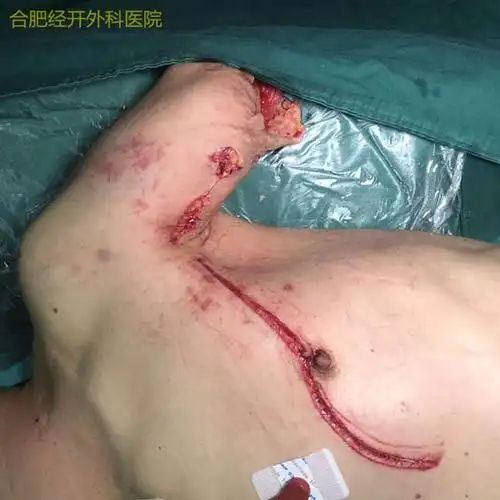 合肥经开外科医院手术展示