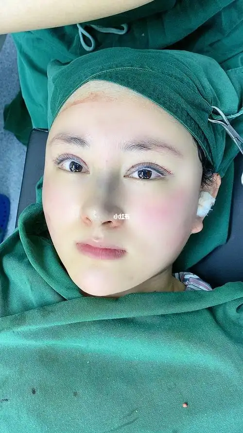 双眼皮术后即刻效果_双眼皮_眼综合_美妆_医美整形