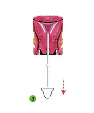 元宫型含铜含吲哚美辛宫内节育器