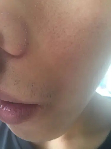 脸上这样白色的是角质吗?