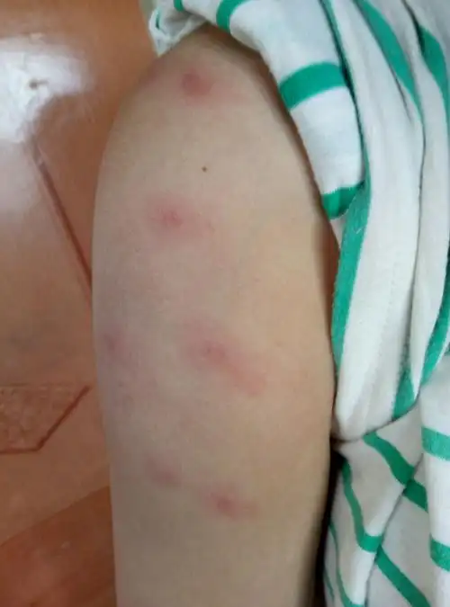 蚊虫叮咬后红包上有小水泡,把小水泡挤破水流出来就不痒了.