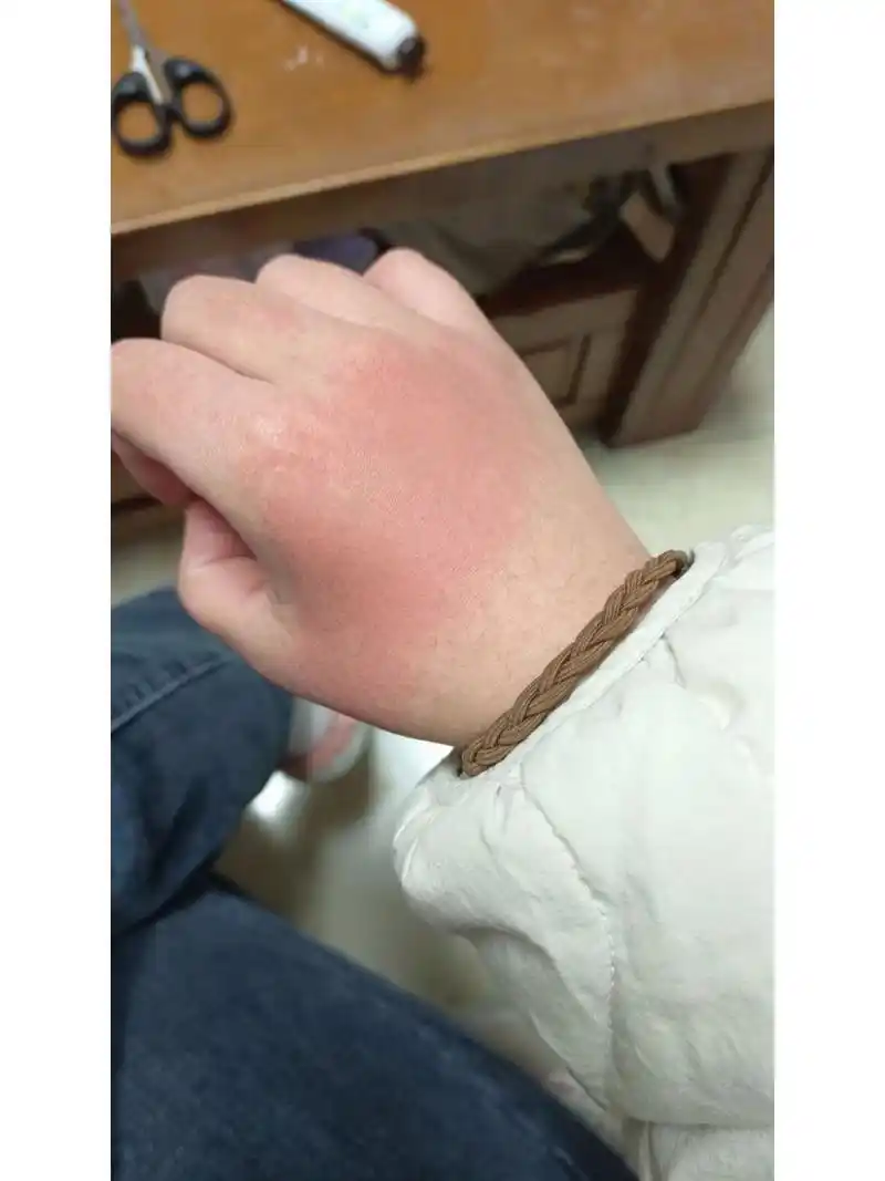 手背莫名其妙红了一片?