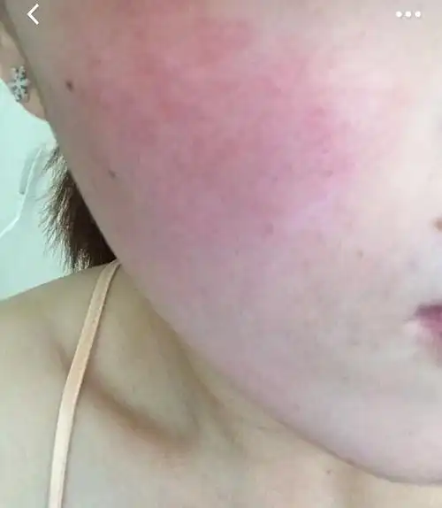 关于脸颊皮肤泛红