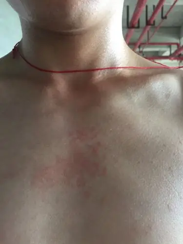 请问我皮肤怎么 就胸口这一块有 而且有差不多一年了 不痛不痒 得了什