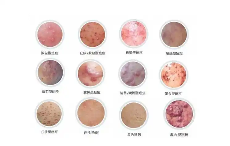 痤疮与毛囊炎区别