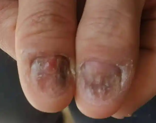 指甲很容易被抠坏