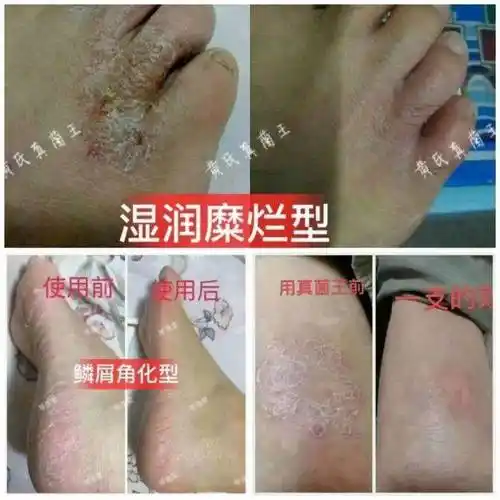 蔡姐专治各种脚气脱皮手足癣湿疹止痒克星:来访必回-流行歌曲改编《在