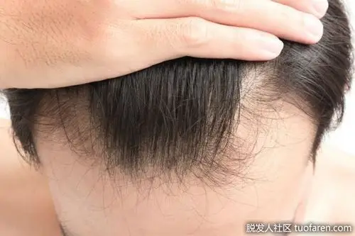 25岁以下男性脱发的3个可能原因