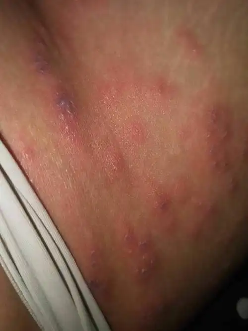 大腿内侧起红疹是什么原因