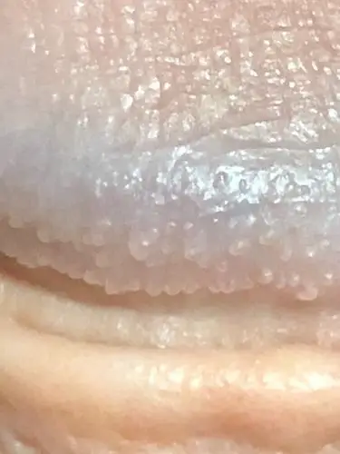 请问这是什么?希望获得的帮助:您好,请问图片中的这个小疙瘩是什么呀?