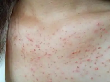 色素性痒疹胸前有大片小红疙瘩图