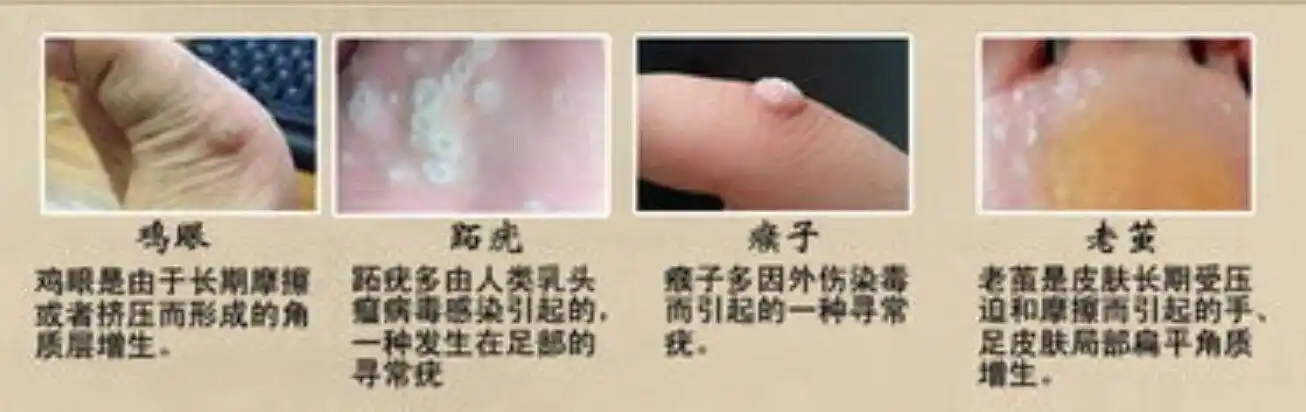 2～5种雍蠊鄄烊缥馊袷疣,则局部变为白色,此为阳性反应假性湿