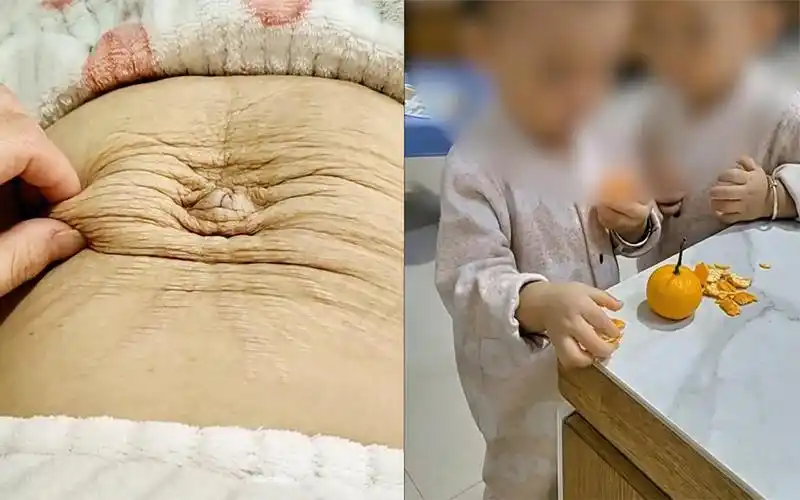 双胞胎宝妈晒产后两年肚子,皮肤暗沉松垮全是褶皱:再也没青春了