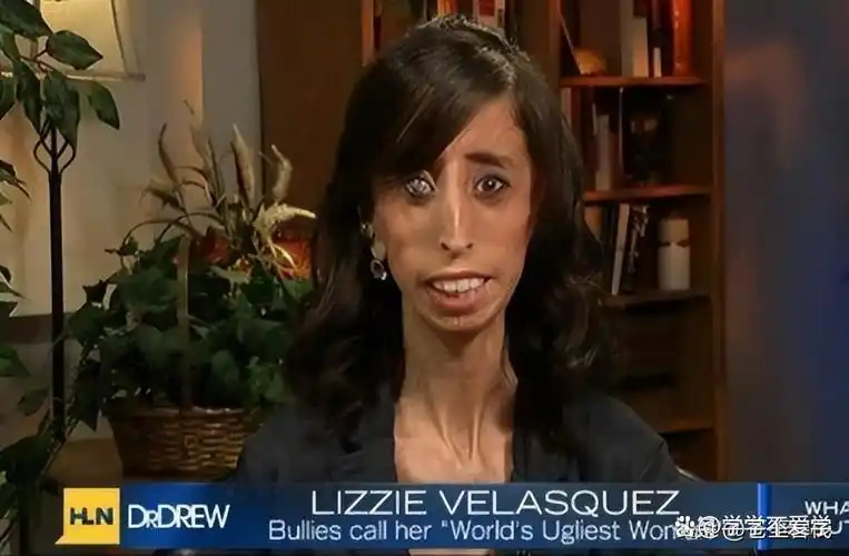 "零脂肪"女孩,也是被吉尼斯世界纪录认证过的世界上最瘦的人其中一个