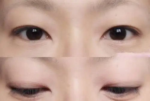 单眼皮和双眼皮到底啥差别?看完就懂了!