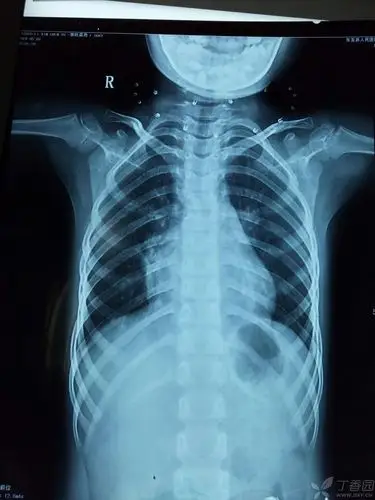双胞胎反复肺炎的原因,及下一步处理. [病例帖]