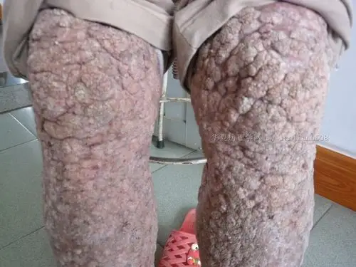 超恐怖的皮肤病变20101206