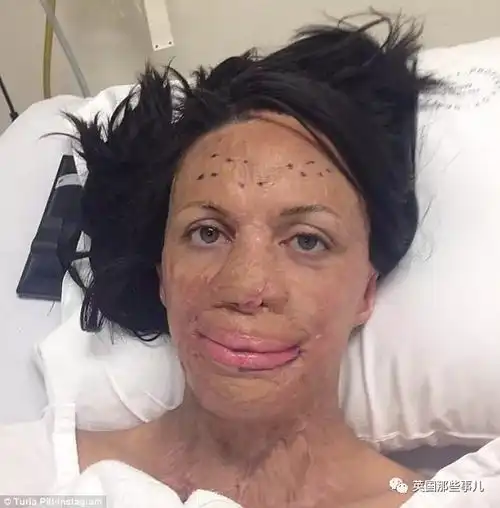 美女模特大火毁容 平均每年做三次整容手术