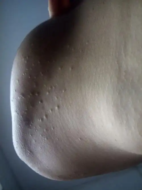 臀部螨虫过敏症状图片