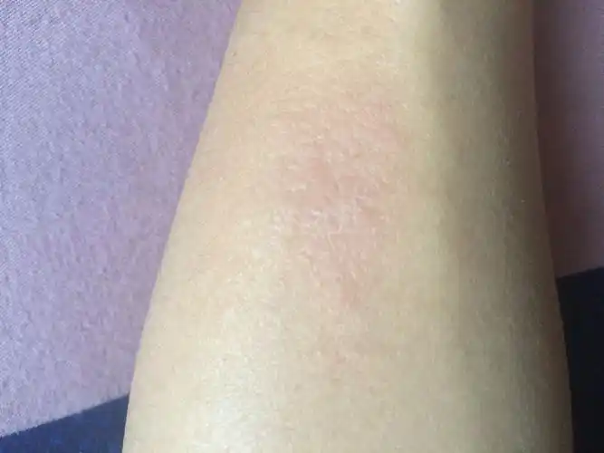 胳膊和脖子后面有两处特别痒,而且皮肤也发生变化,请问是什么原因