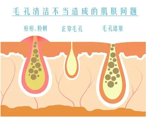 答案是毛孔清洁!清洁不彻底容易导致肌肤问题!
