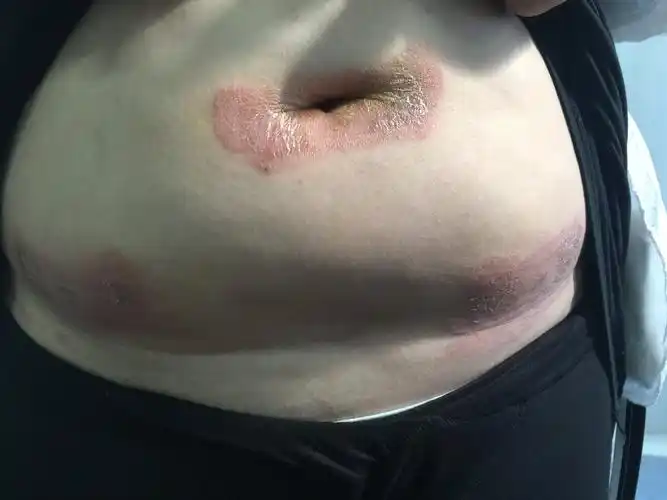 常见皮肤病图谱2 - 好大夫在线