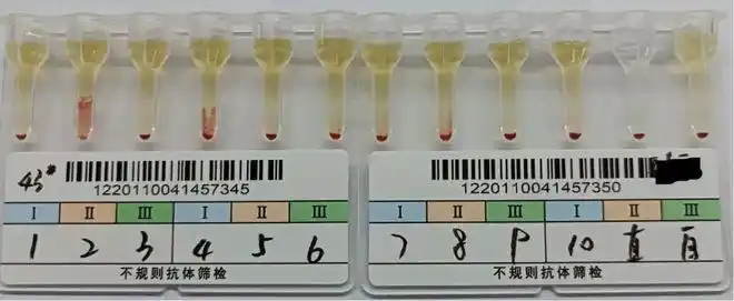 抗-m导致abo血型正反定型不符一例