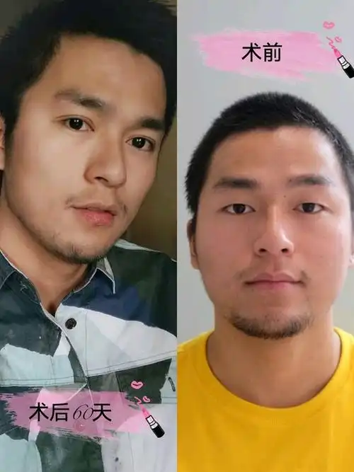 新氧- 城市迷宫里 | 切开双眼皮 | 重庆同城 | 小哥哥超帅哒 | 真人