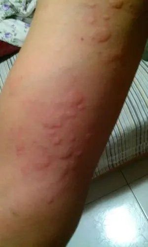 (发病时间,主要症状等): 越挠多多吧 痒的晃 都是硬疙瘩 是不是过敏呀