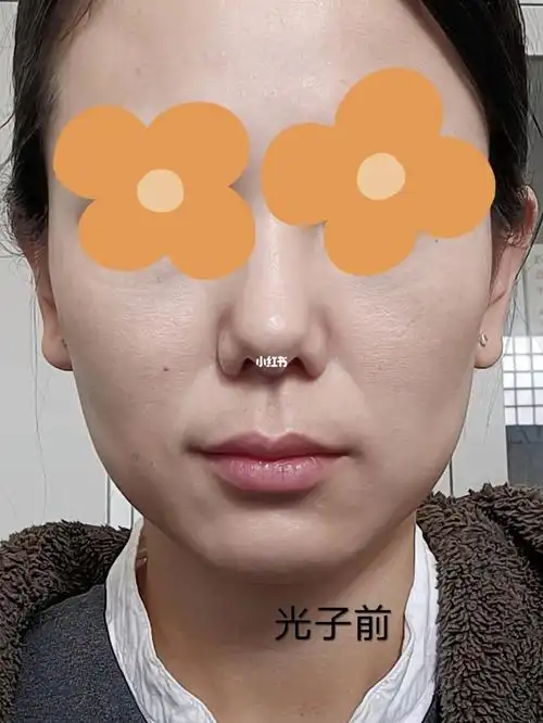 枣庄光子嫩肤10天效果对比_光子嫩肤_辣子鸡_面膜_光子嫩肤m22_美妆