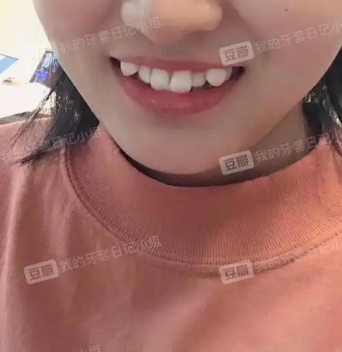 有没有两颗虎牙高位突出的友友呀!