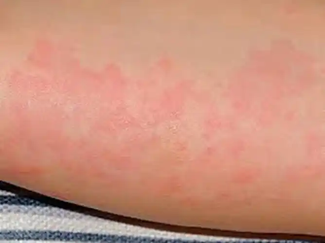 夏季皮炎图片_夏季皮炎症状表现图片大全_有来医生