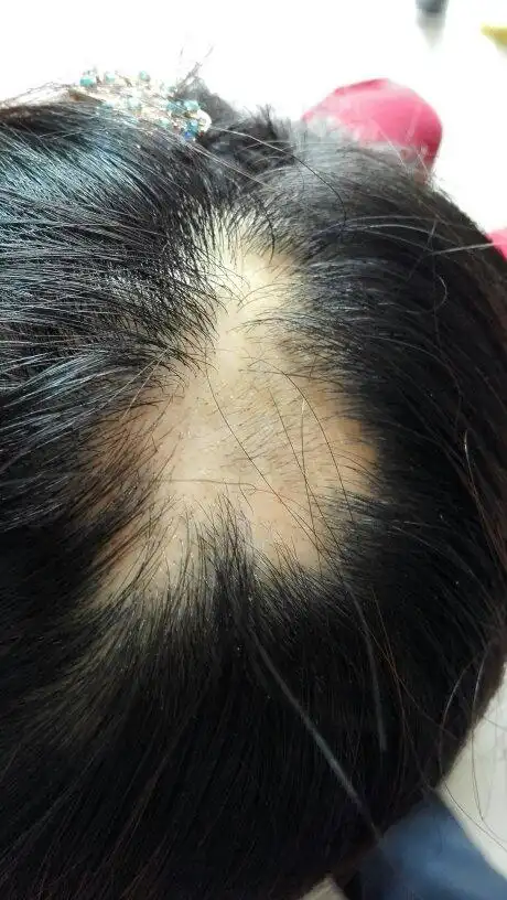 我烫染头发!导致现在头发在一小快的脱落!