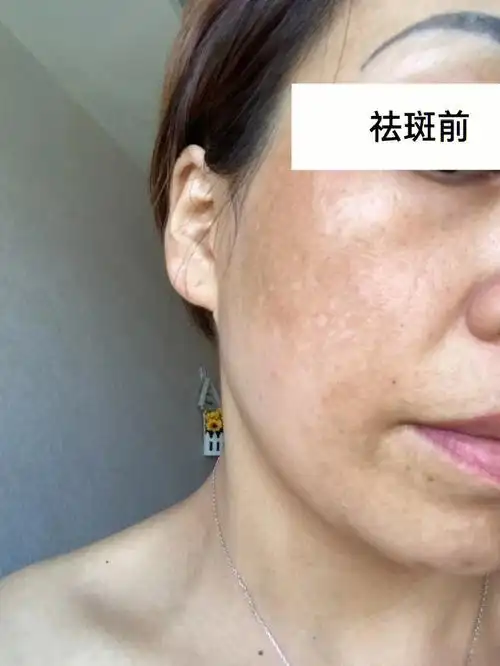 什么样的人容易长黄褐斑