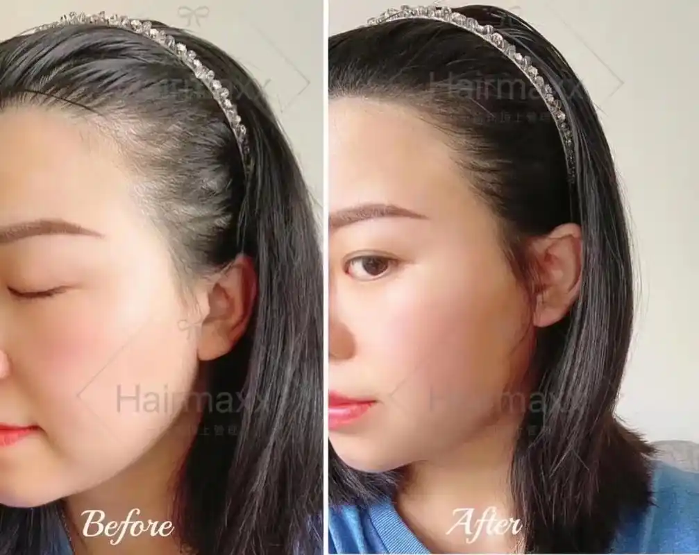 怎样的发际线才是标准好看的呢? - 抖音