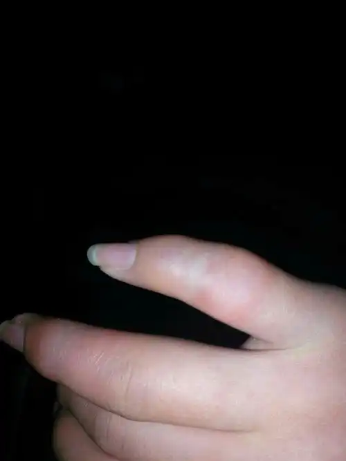 我的小手指那肿了,有点儿发青了,严重吗,该怎么办,我左手的中指关节那