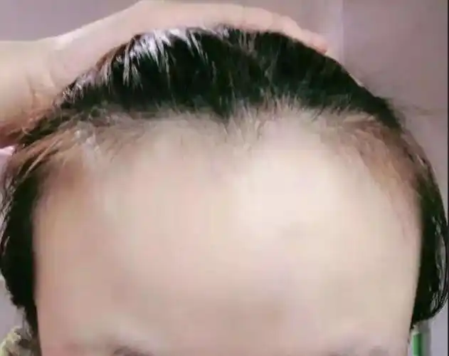 发际线似乎一直上移?听说是总这样梳头发的过,赶紧放弃了马尾辫