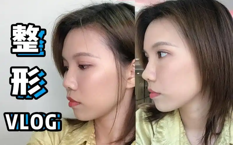 第一次打玻尿酸丨垫了鼻基底,凸嘴改善了,鼻子高了