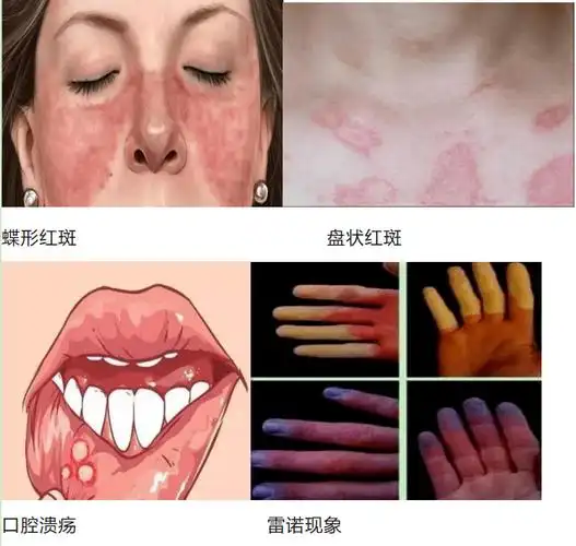 一文带你了解系统性红斑狼疮