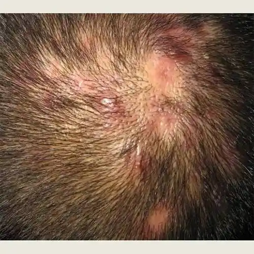 头部有毛囊炎用什么洗发水