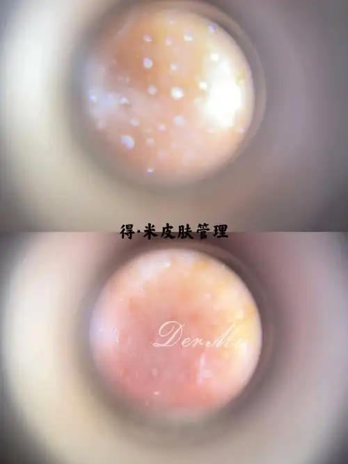 黑头|毛孔疏通啦～