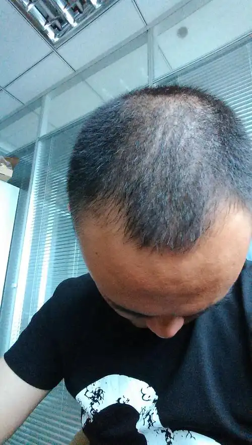 25周岁 男 头皮油