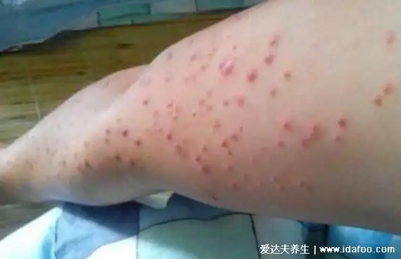 艾滋病最初皮疹图片,出现溃烂皮炎/单纯疱疹/带状疱疹需警惕