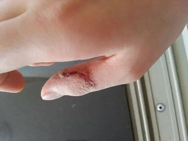 这种程度的割伤需要去医院处理缝线吗?