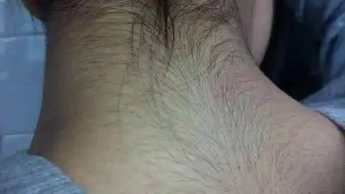 女生体毛旺盛的原因是什么:女生体毛多该怎么办