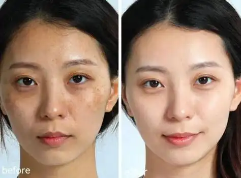 淡斑效果好的护肤品,祛斑美白最好的产品是哪一款?