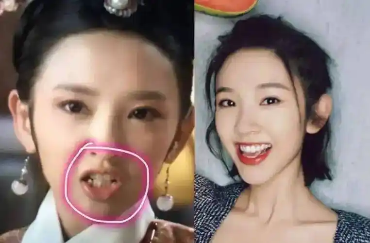 明星的一口乱牙,范冰冰唐嫣整牙后提升颜值,看到男爱豆我崩溃了_牙齿