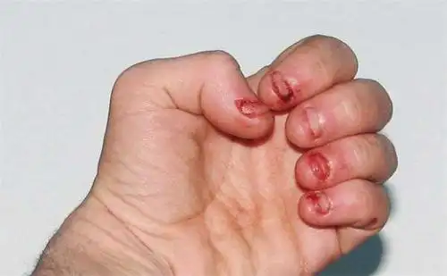 每当他一紧张总会啃咬指甲,不料这个看似没什麼的坏习惯竟然引发严重