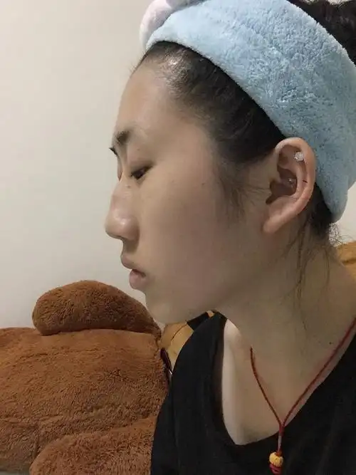 想知道这样的驼峰鼻该做什么样的项目?