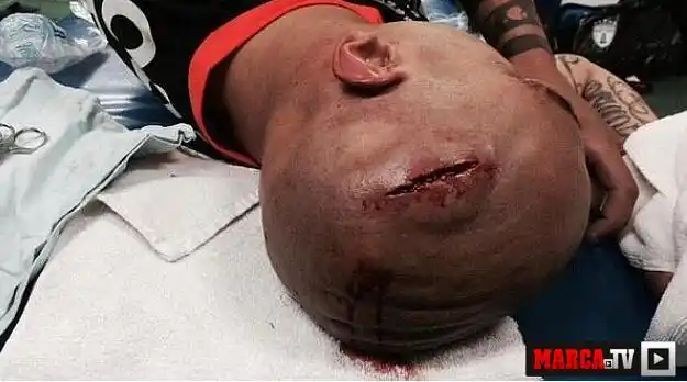 球员赛场遭"爆头" 10公分伤口触目惊心